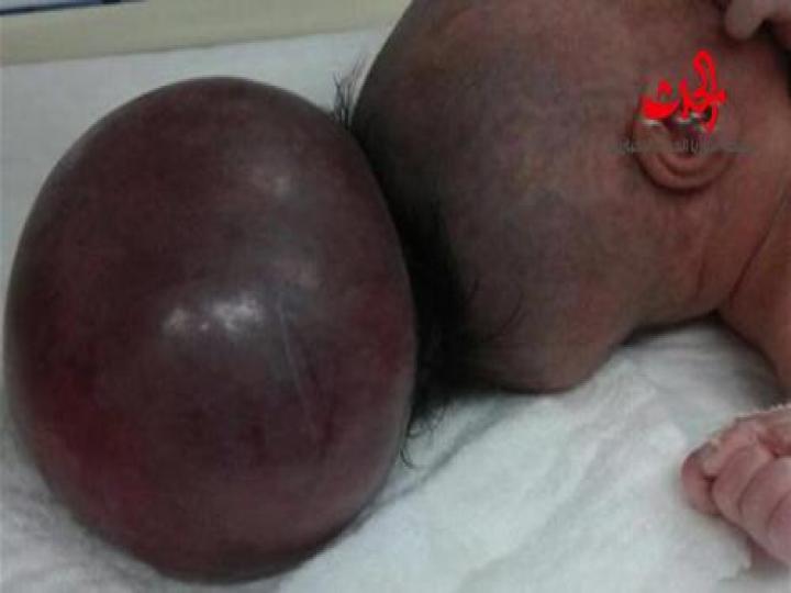 بالصور نجاح عملية جراحية لطفلة ولدت برأس إضافي