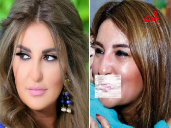 بالصورة شاهد ماذا حصل بشفاه شذى حسّون؟