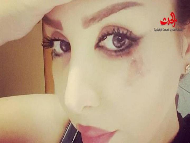 ملكة جمال سورية والعرب تعرضت لحادث وتشوّهت جزئياً
