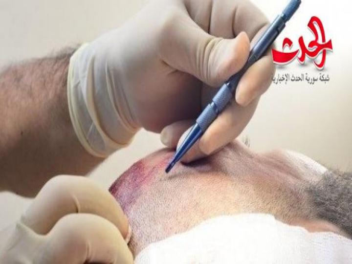 زراعة الشعر بتقنية الاقتطاف  