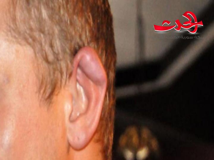 لماذا تبدو آذان المصارعين والفنون القتالية مشوهة!