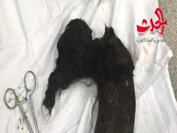حالة غريبة.. في روسيا عملية جراحية ناجحة لفتاة تأكل شعرها! 