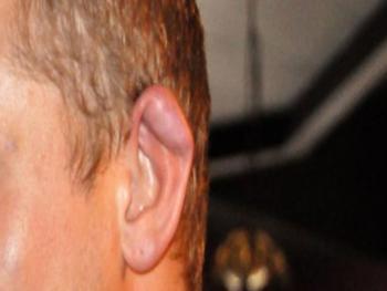 لماذا تبدو آذان المصارعين والفنون القتالية مشوهة!