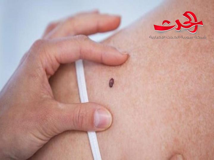 هل “الشّامة” سبب من أسباب سرطان الجلد؟
