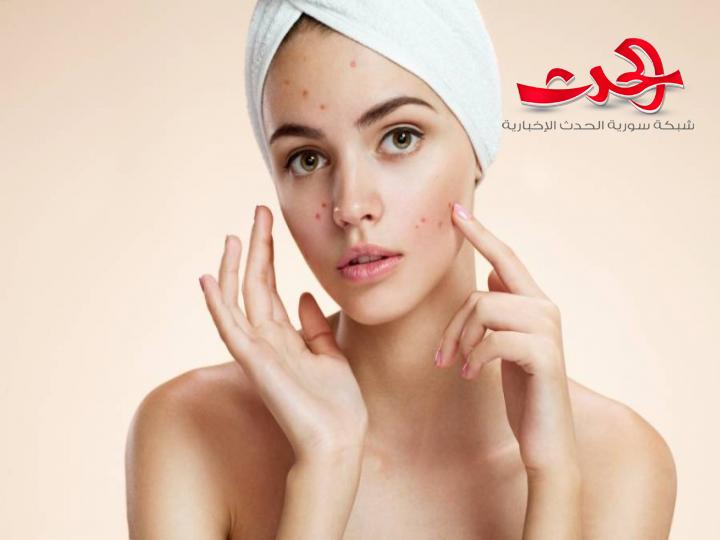 10 طرق لعلاج مشكلة حَب الشباب