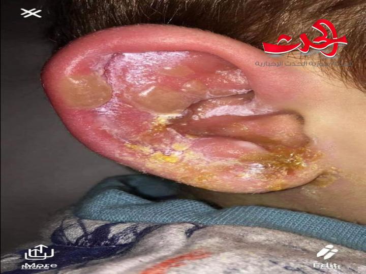 "قُبلة" تحول حياة طفل إلى جحيم مدى الحياة