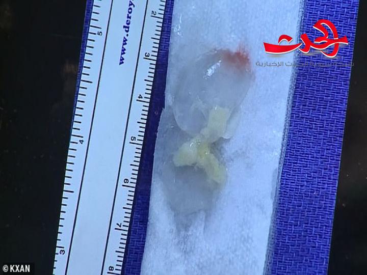 صراع مع الصداع لـ عشرة أعوام والسبب دودة في المخ