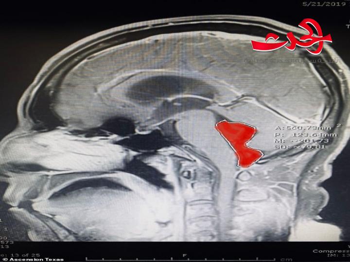 صراع مع الصداع لـ عشرة أعوام والسبب دودة في المخ