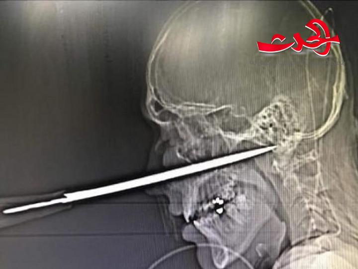 ملاكم ينجو من الموت بأعجوبة بعد أن اخترقت السكين راسه