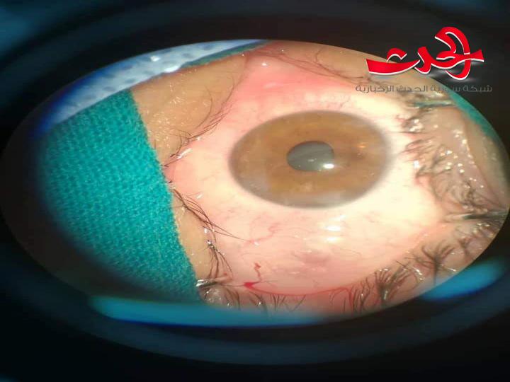 ورشة عمل حول زرع العدسات العينية رؤية علمية جديدة بالسويداء