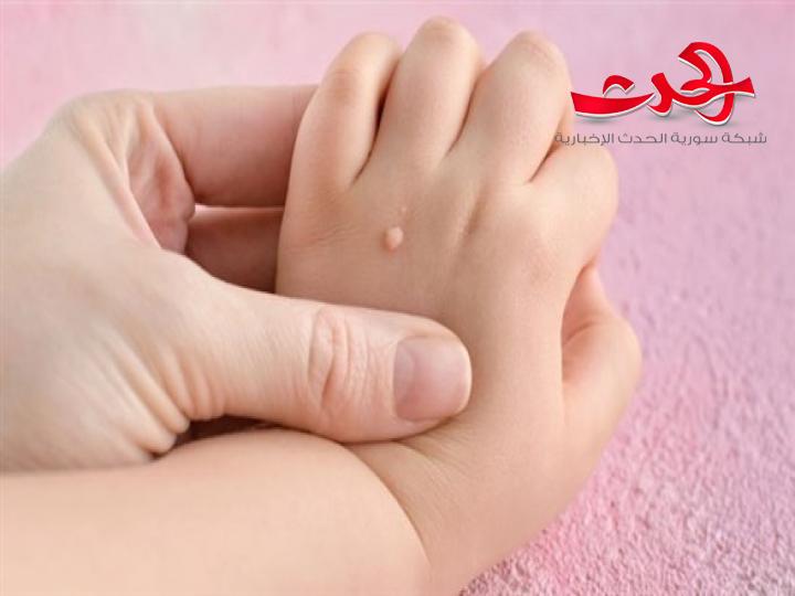 ما هي اسباب الثآليل التي تظهر لدى الااطفال