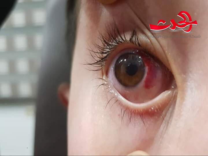 عين طفل تتأذى بمسدس الخرز في اول ايام عيد الفطر السعيد
