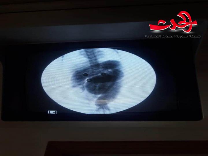 مشفى الشرطة بحرستا يجري عملية نوعية لطفلة