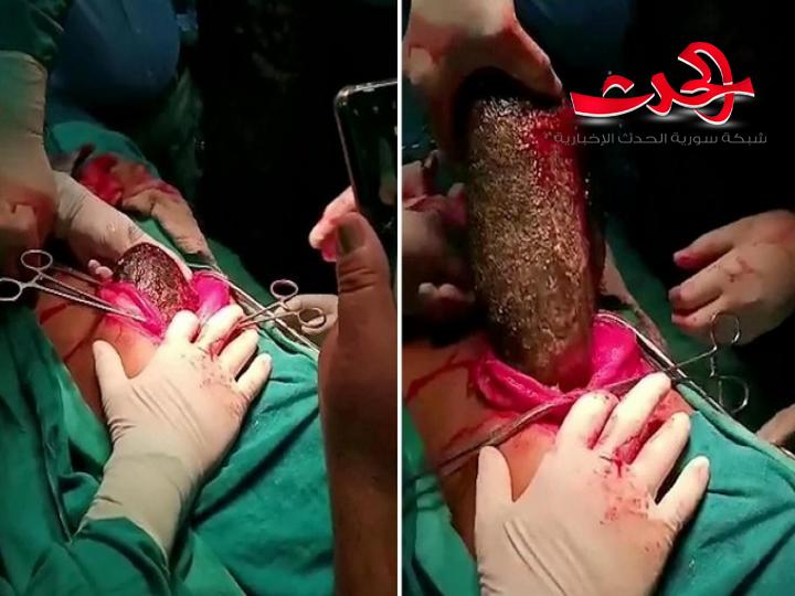 شاهد بالصورة.. سحب كتلة شعر ضخمة من معدة فتاة تقضم شعرها