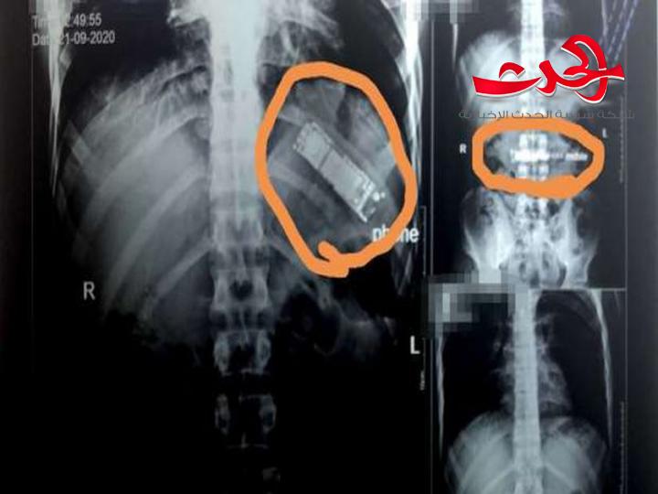 العثور على هاتف محمول في معدة مواطن مصري