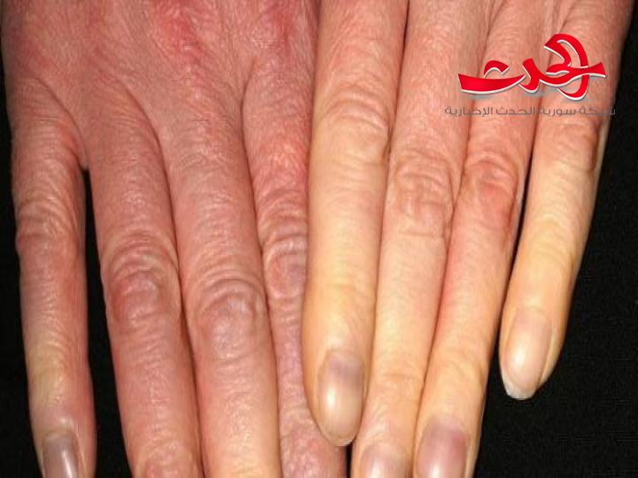 Raynaud's Disease مرض رينود وتاثيره على مرضى السكري