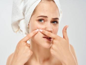 10 طرق لعلاج مشكلة حَب الشباب