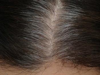 ما هي الأسباب الرئيسية لفقدان لون الشعر في سن مبكرة؟