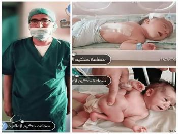 مشفى الأطفال الجامعي بدمشق يجري عملية ناجحة لفصل توأم سيامي