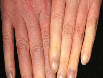 Raynaud's Disease مرض رينود وتاثيره على مرضى السكري