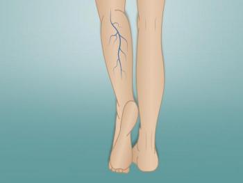 علامات ظهور دوالي الساقين Varicose veins... العلاج النهائي لمدة شهر كامل