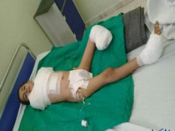 بتر ثلاثة اطراف للطفل يزن الذي صعقته الكهرباء فهل يتعظ المسؤولون؟