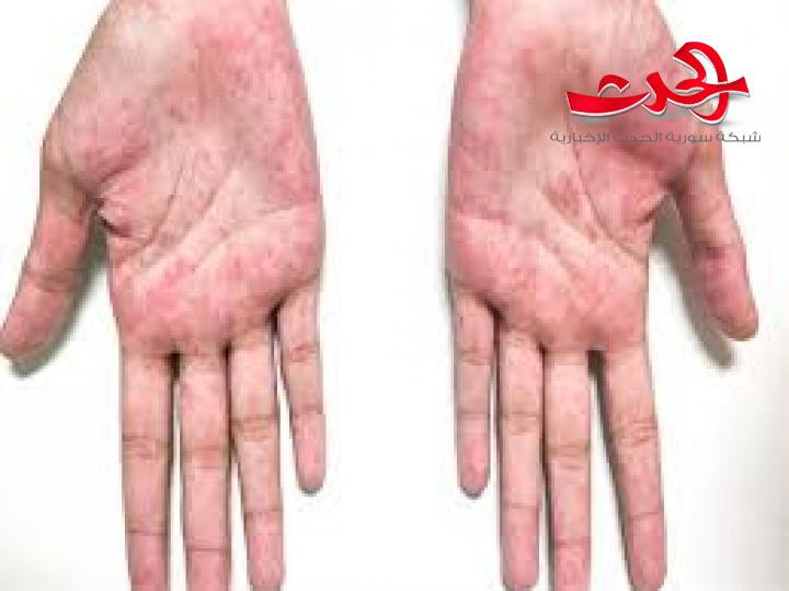 رئيس قسم الاطفال بمشفى المجتهد: فايروس كورونا يزيد من فرصة الاصابة بمتلازمو كاواساكي عند الاطفال