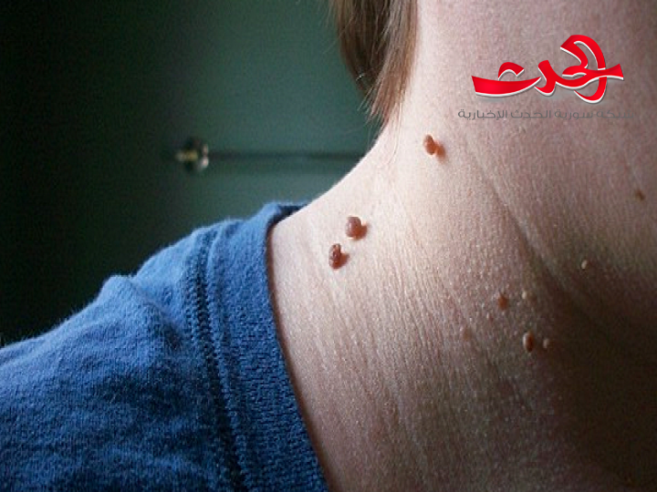 التخلص من الثؤلول والبثور الموجودة على الجلد!