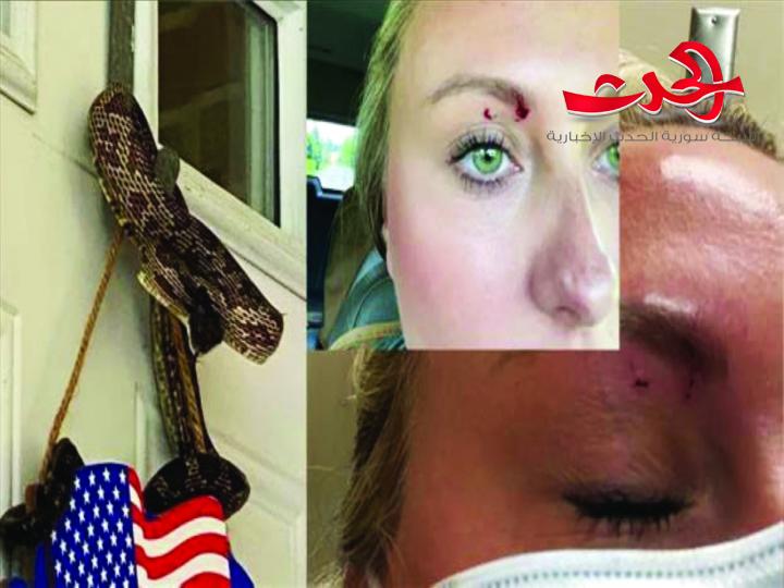 بالصورة-أفعى تطرق باب أمريكية وتلدغها في عينها