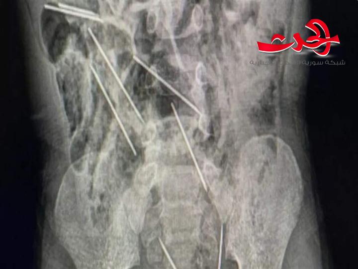 طفل يبتلع ثماني إبر حقن لتطعيم الحيوانات..صور